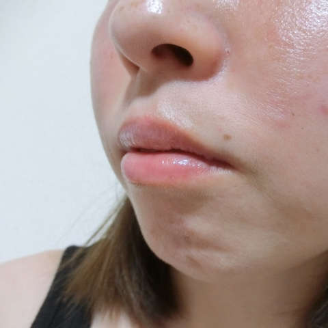 Khách hàng đánh giá về bộ sản phẩm ngăn ngừa mụn Neutidi