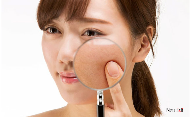 Da nhiều dầu nhờn, lỗ chân lông to nên sử dụng niacinamide