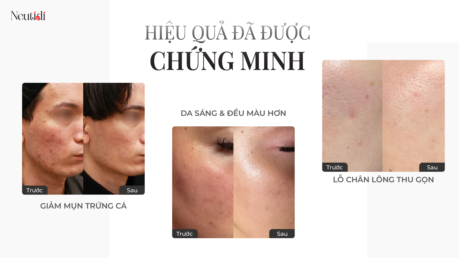 hieu qua cua serum neutidi niacinamide