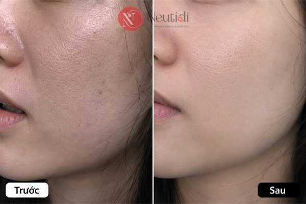 Trải nghiệm Serum La Roche-Posay Retinol B3 se khít lỗ chân lông