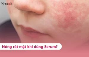 Nóng rát mặt khi dùng serum