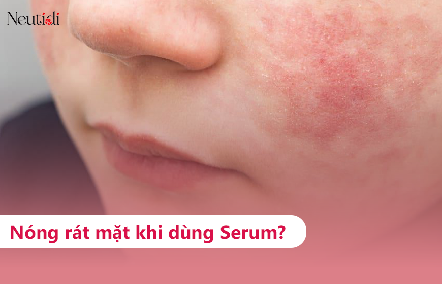 Nóng rát mặt khi dùng serum