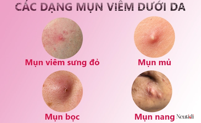 Phân loại mụn viêm dưới da thường gặp