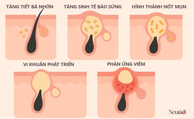 Quá trình hình thành mụn viêm