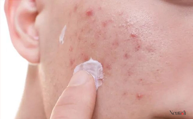 Cách trị mụn viêm đỏ không có nhân hiệu quả nhất