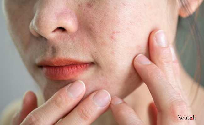 Hướng Dẫn Cách Sử Dụng Serum Hiệu Quả Cho Da Khỏe Đẹp 4 Tiêu chí & hướng dẫn chọn serum cho da mụn
