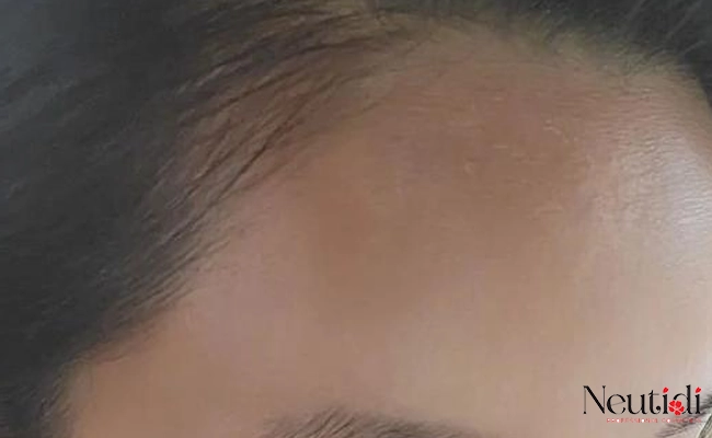 Da bị bắt nắng, sạm đen do dùng serum