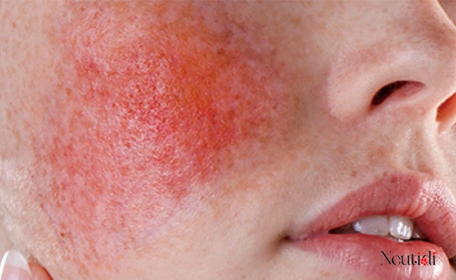 Dấu hiệu trên da cho thấy serum có chứa corticoid