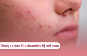 Dùng serum niacinamide bị đẩy mụn