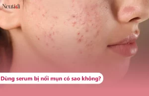 Dùng serum bị nổi mụn