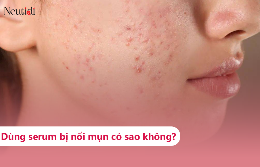Dùng serum bị nổi mụn