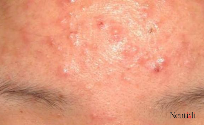 Sử dụng serum niacinamde bị đẩy mụn, nổi mụn