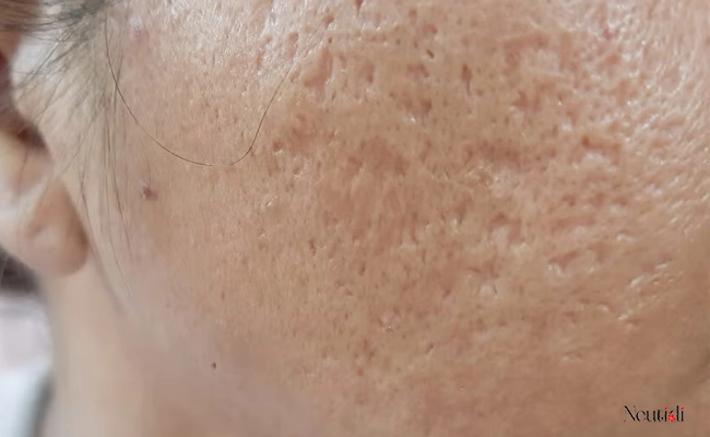 Sẹo thâm, sẹo rỗ do xử lý mụn viêm đỏ không nhân sai cách