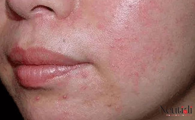 Hậu quả khi cố dùng tiếp serum đã hỏng