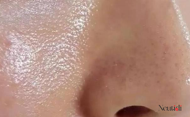 Hỗ trợ giảm dầu thừa với serum B3