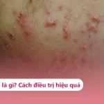 Mụn Viêm Là Gì? Nguyên Nhân, Cách Chăm Sóc & Trị Mụn Viêm Hiệu Quả Mụn viêm là gì?