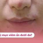 Mụn viêm dưới da: Nguyên nhân, phân loại và cách trị hiệu quả