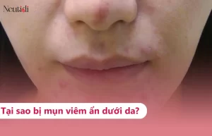 Mụn viêm dưới da: Nguyên nhân, phân loại và cách trị hiệu quả