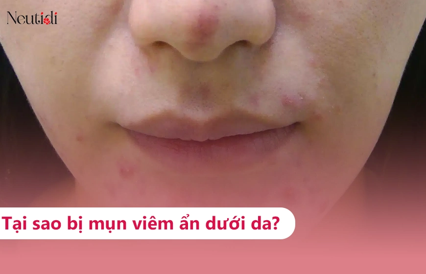 Mụn viêm dưới da: Nguyên nhân, phân loại và cách trị hiệu quả
