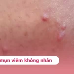 Mụn viêm đỏ không nhân là gì? Cách xử lý và trị tận gốc hiệu quả Mụn viêm đỏ, không có nhân