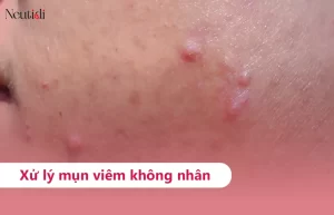 Mụn viêm đỏ, không có nhân