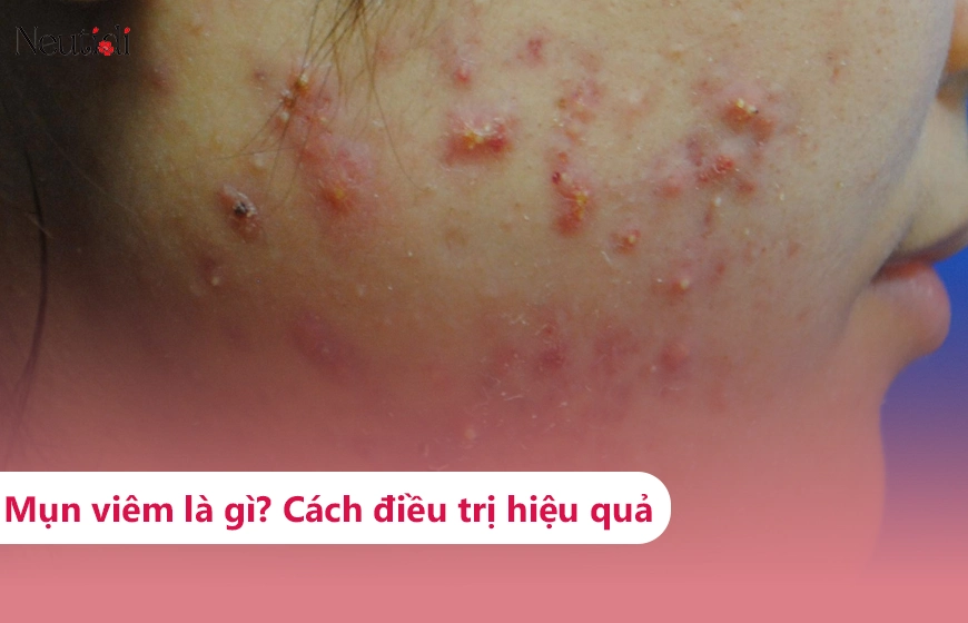 Mụn viêm là gì?