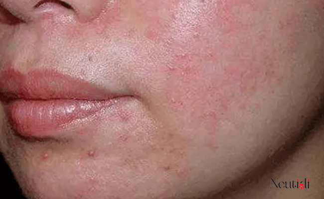 Nguyên nhân gây nổi mụn khi dùng niacinamide