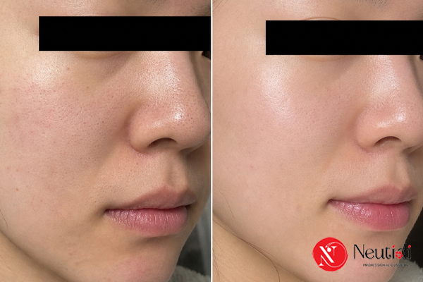 Serum tẩy tế bào chết giúp thu nhỏ lỗ chân lông