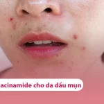 Top các loại serum niacinamide cho da dầu mụn