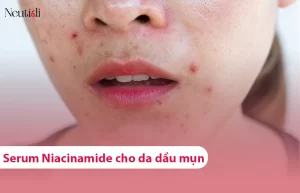 Top các loại serum niacinamide cho da dầu mụn