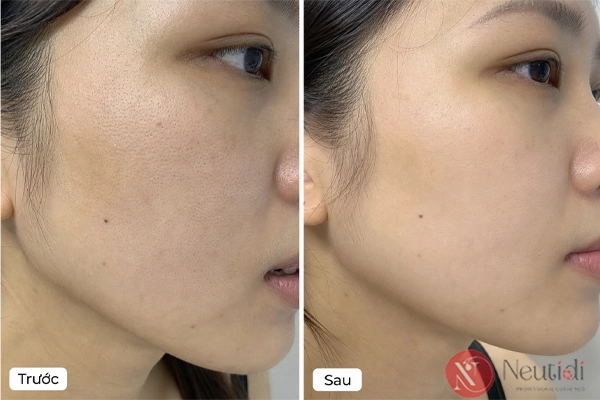 The ordinary serum thu nhỏ lỗ chân lông cho da dầu