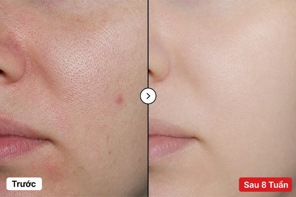 Hiệu quả thu nhỏ lỗ chân lông của serum Neutidi Niacinamide