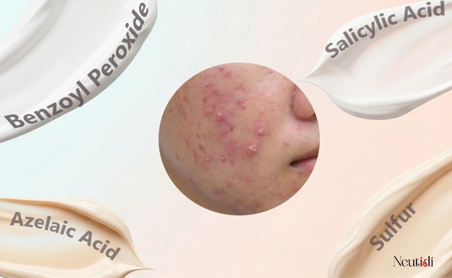 Cách trị mụn viêm bằng thuốc bôi