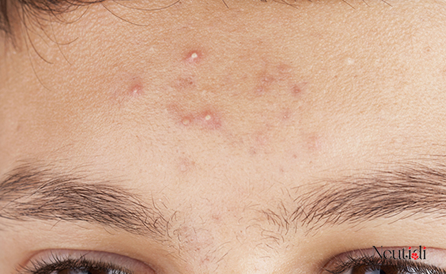 xử lý tình trạng nổi mụn khi dùng serum