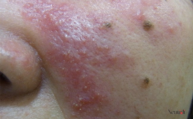 Một số loại mụn viên ở má thường gặp nhất