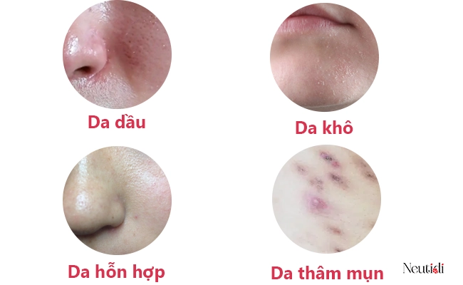 Chọn serum trị mụn đầu đen và mụn ẩn phù hợp cho từng loại da