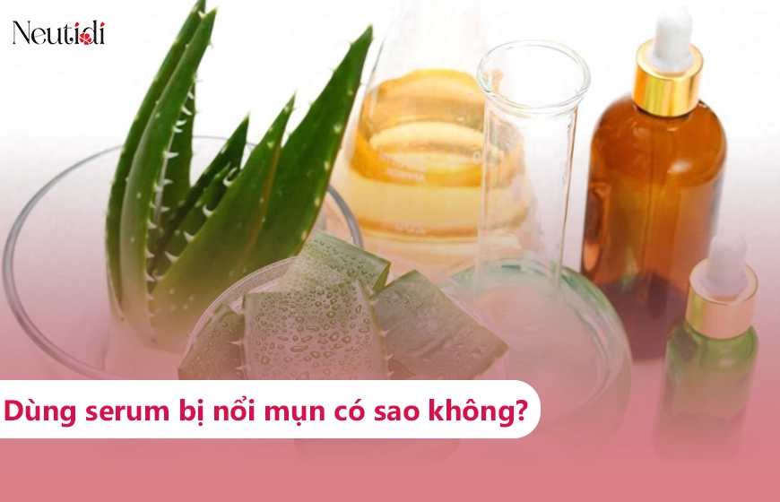 Hướng dẫn cách trị mụn bằng gel nha đam hiệu quả tại nhà (cập nhật 2025)