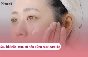 Có nên dùng niacinamide sau khi nặn mụn?