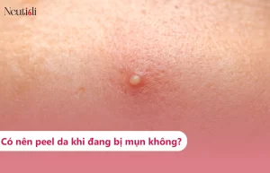 Có nên peel da mụn trứng cá, mụn viêm, mụn đầu trắng/đen không?