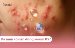 Da mụn có nên dùng serum B5 hay không?