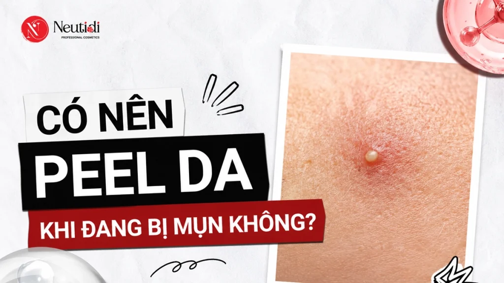Da mụn có nên peel không?