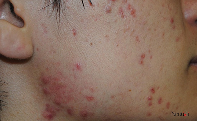 Đặc điểm của da mụn