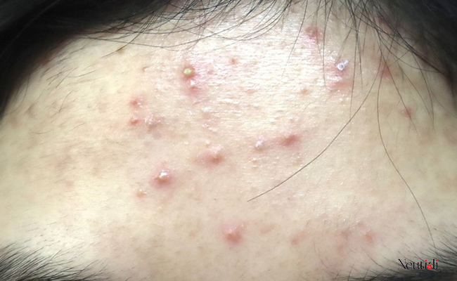 Đặc điểm nhận biết mụn viêm vùng trán chính xác