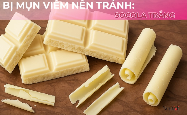 Socola sữa - người bị mụn viêm cần kiêng