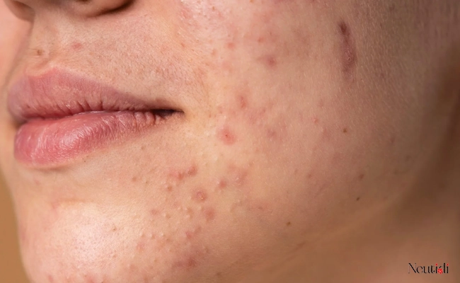 Có kết hợp dùng chung niacinamide với azelaic acid được không