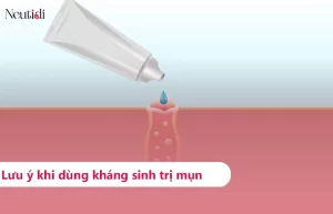 Trị mụn viêm bằng kháng sinh
