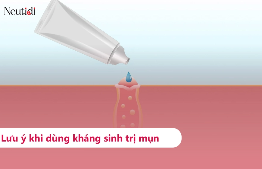Trị mụn viêm bằng kháng sinh