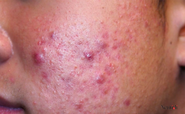 Các trường hợp nên trị mụn với kháng sinh