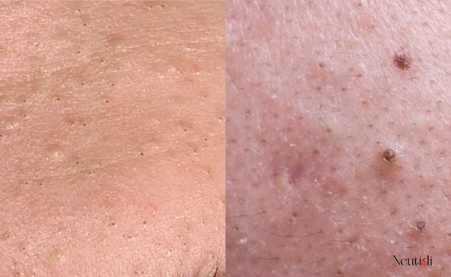 Tình trạng mụn đầu đen và mụn ẩn ở nhiều người