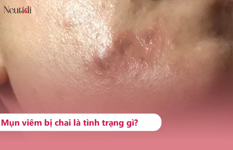 Mụn viêm bị chai